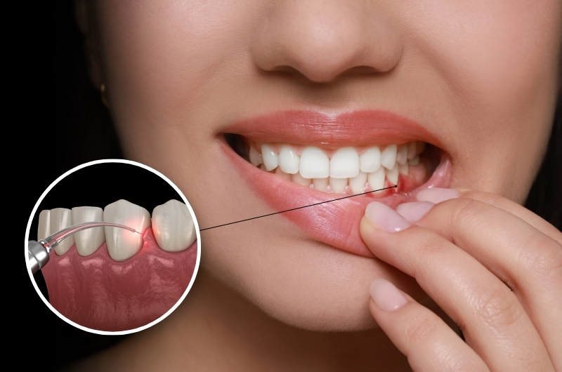 Gum Treatment Overview